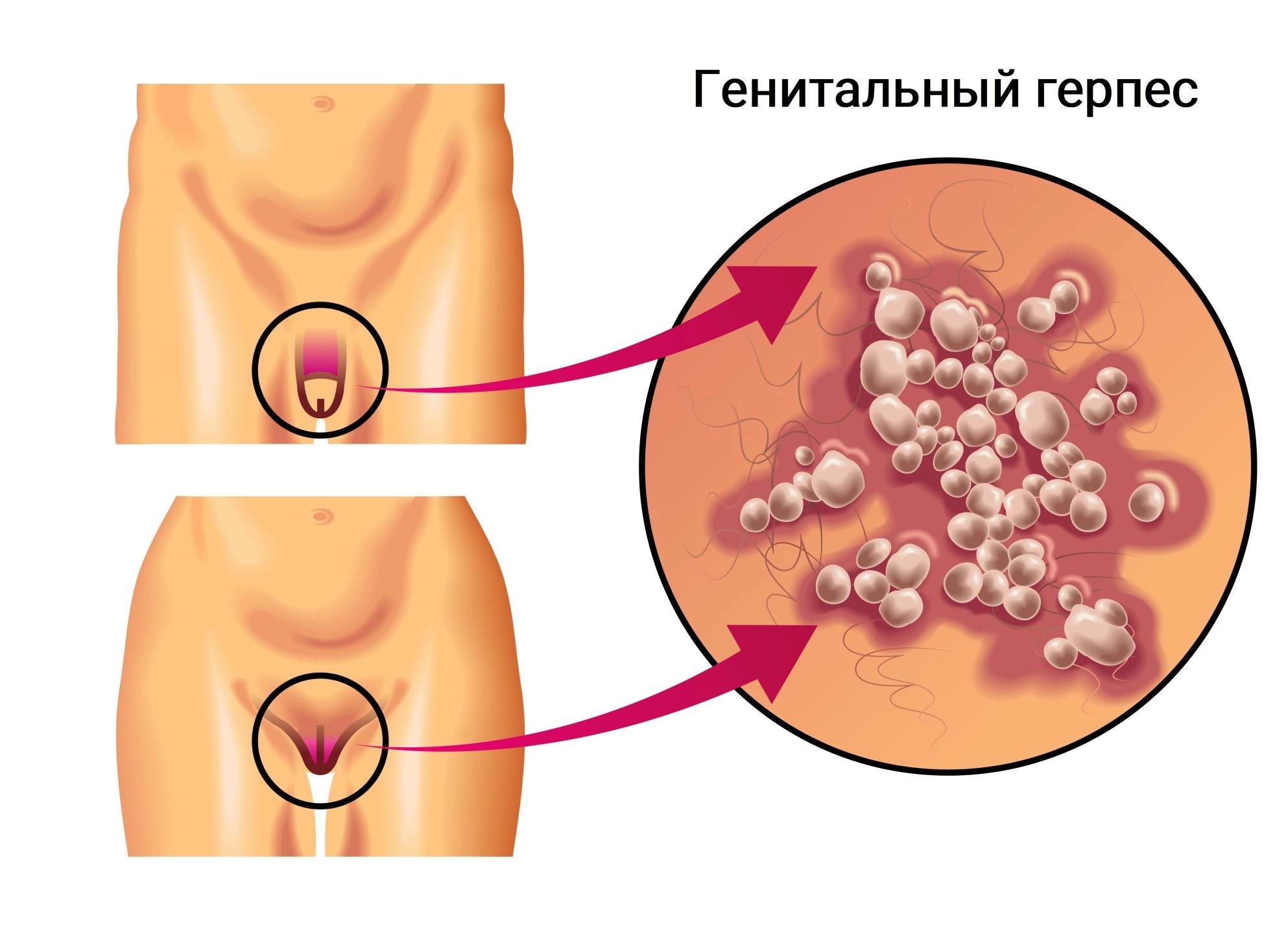 Генитальный герпес что это