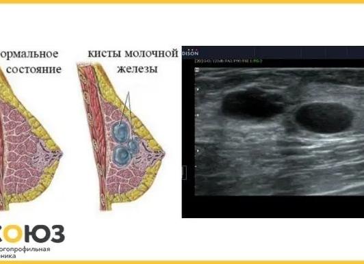 Эхогенное образование в молочной железе
