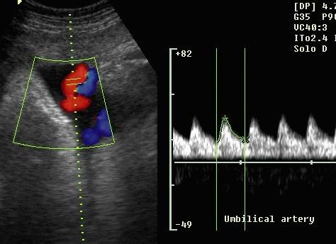 Допплерометрия в акушерстве