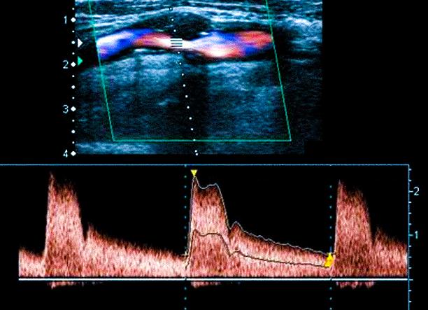 Что показывает узи вен и артерий нижних конечностей