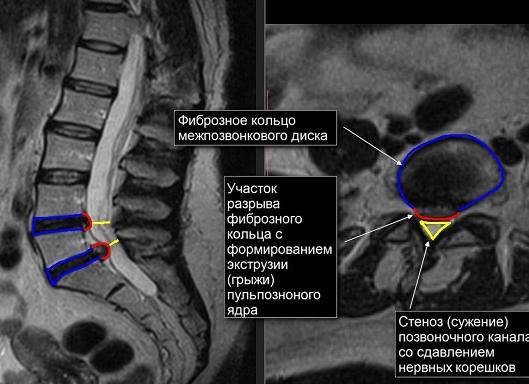 Что показывает мрт позвоночника поясничного отдела