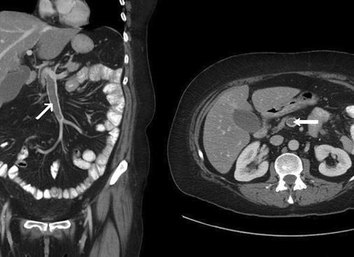 Что покажет мрт брюшной полости и забрюшинного пространства