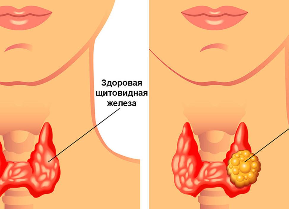 Чем опасны узлы щитовидки