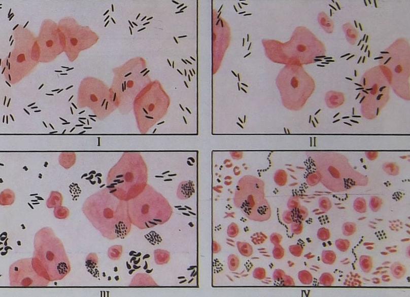 2 степень чистоты в гинекологии