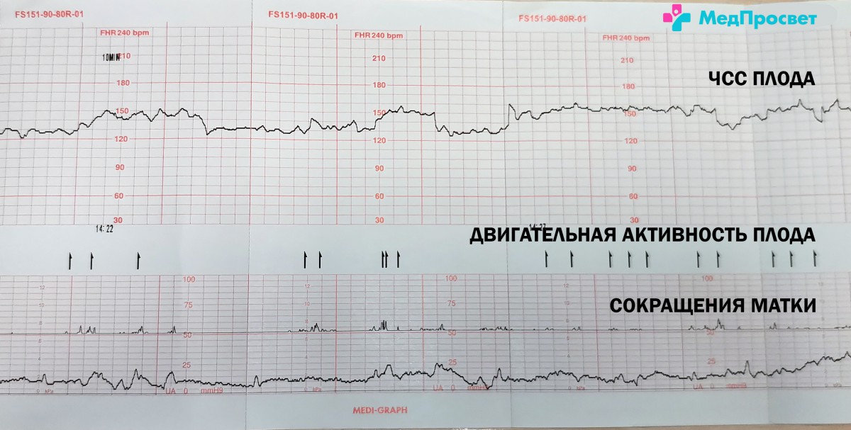 Ктг плода норма
