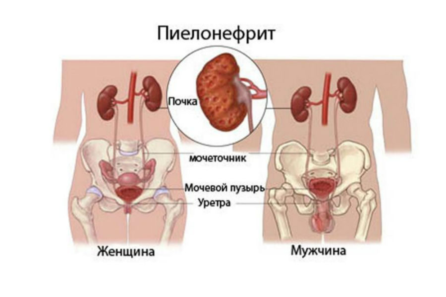 Лейкоцитурия что это