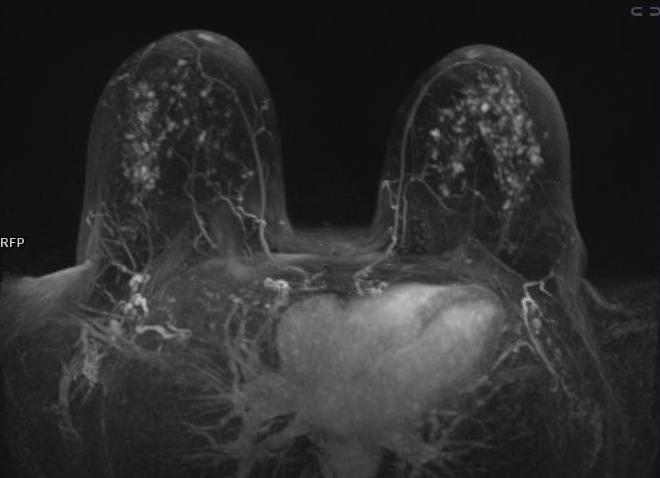 Мрт молочной железы с контрастированием Мрт молочной железы с контрастированием
