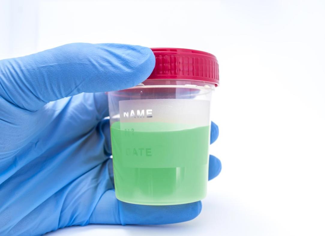 Моча зеленого цвета у взрослого причины