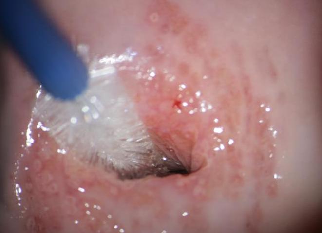 Мазок на ак с шейки матки что это такое