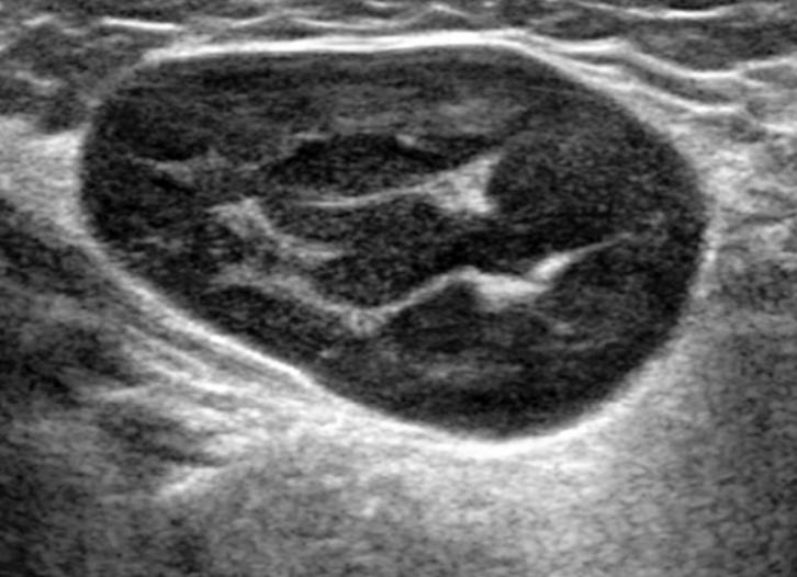 Лимфоузлы на узи при лимфоме Лимфоузлы на узи при лимфоме