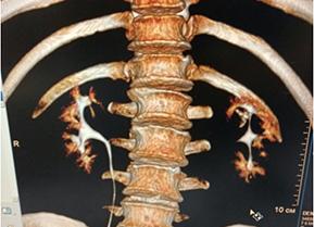 Кт поясничного отдела Кт поясничного отдела