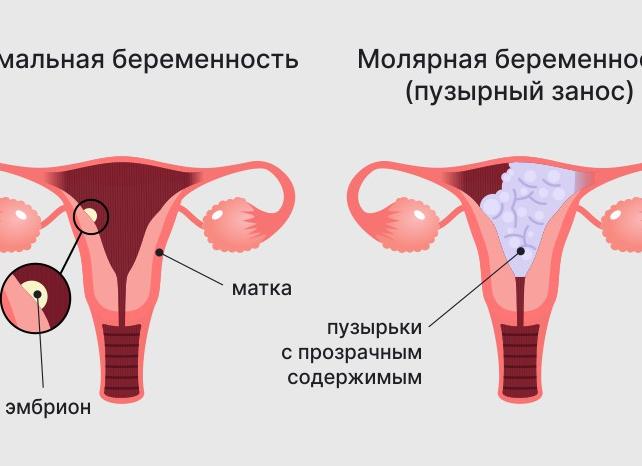 Кровь на ранних сроках Кровь на ранних сроках