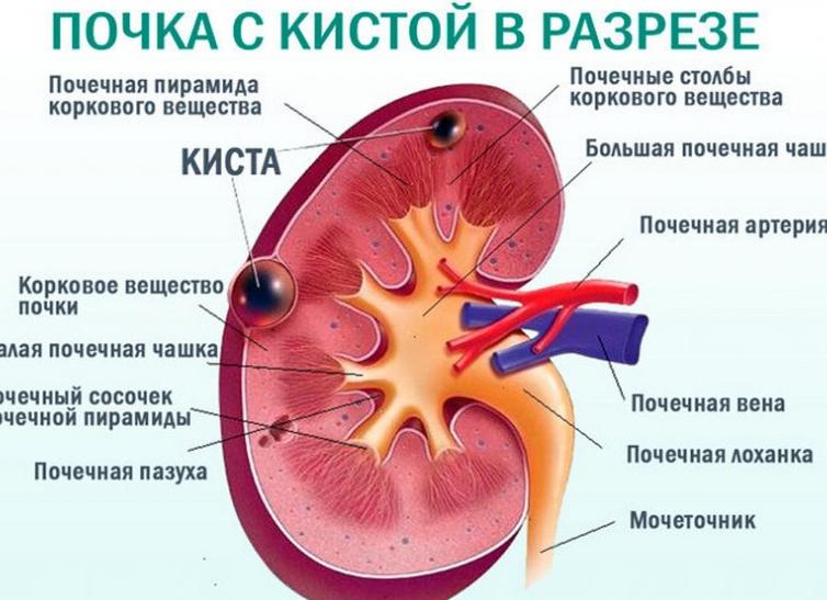 Киста почки паренхимы