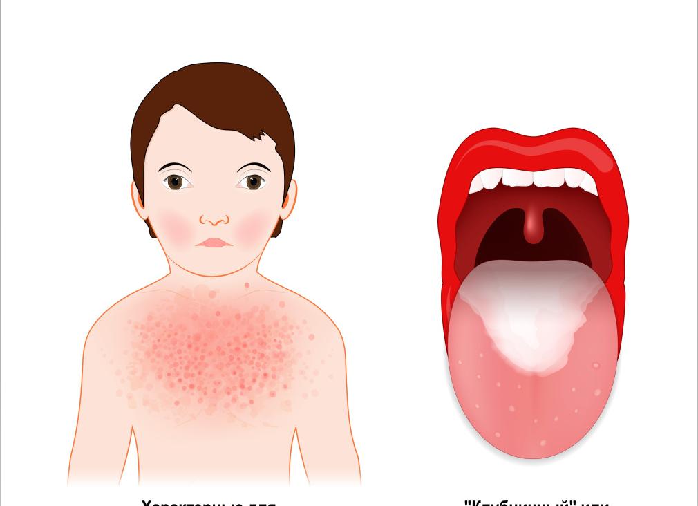 Как лечить стрептококки в горле