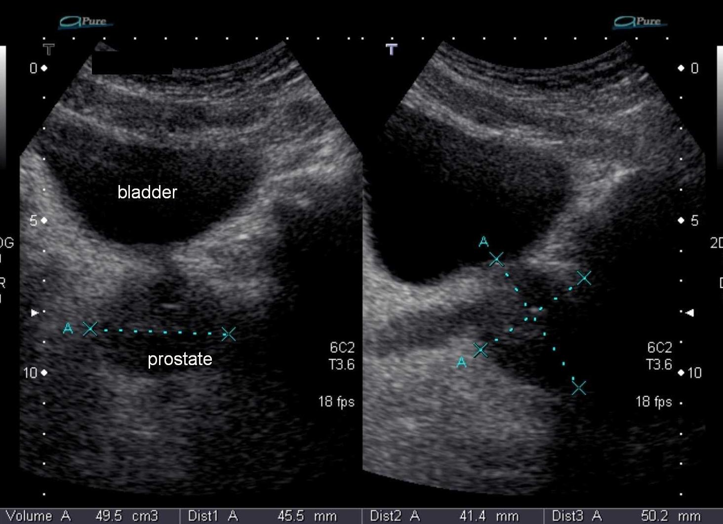 Исследование предстательной железы трансабдоминальное