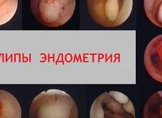 Фиброзный полип эндометрия