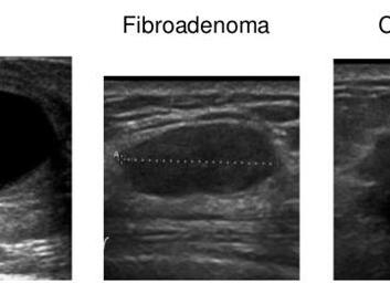 Фиброаденома молочной железы фото узи