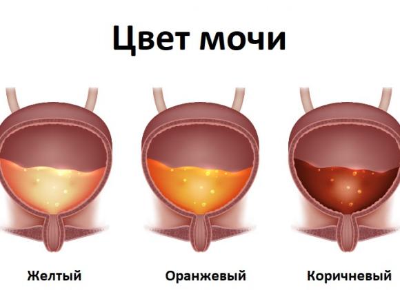 Цвет мочи при повышенных лейкоцитах