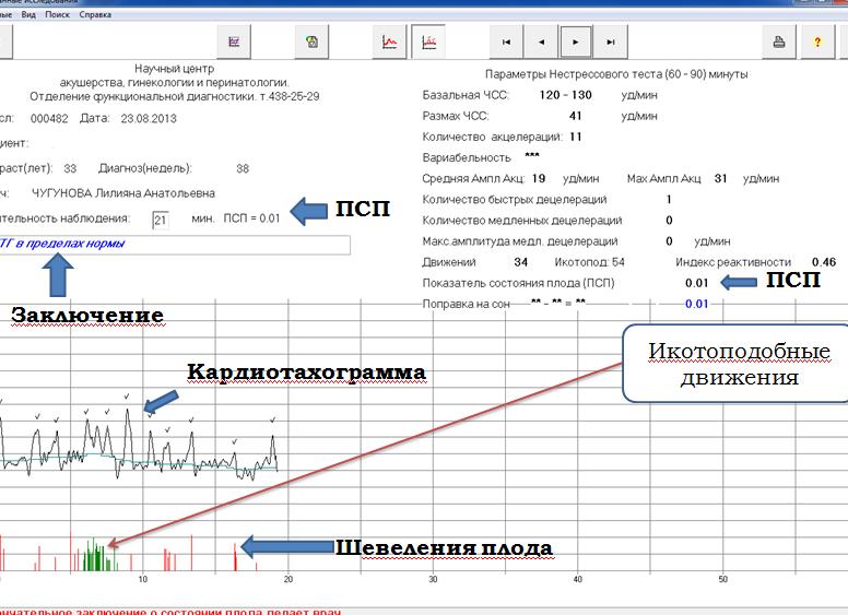 Что такое токо на ктг