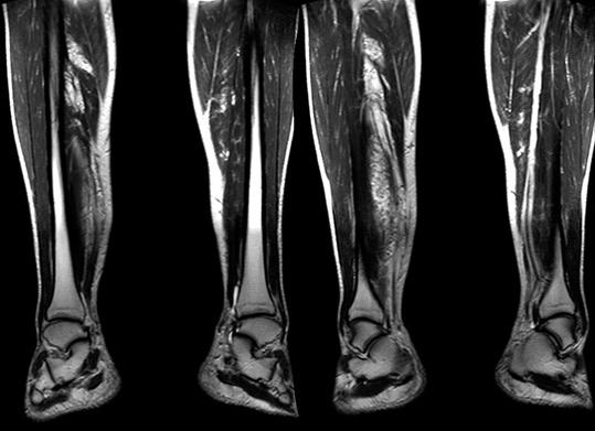 Что показывает мрт нижних конечностей