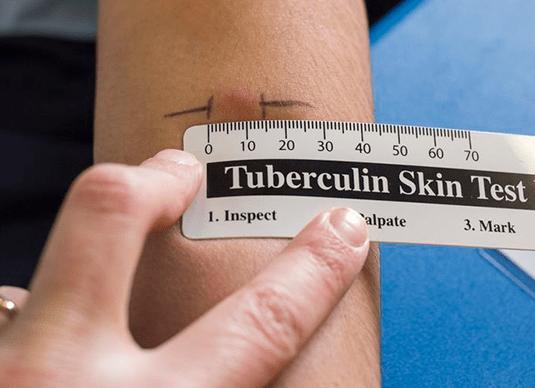 Что делают вместо манту