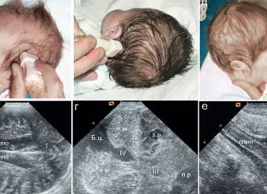 Асимметрия боковых желудочков у грудничка