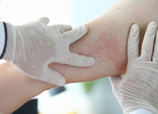 Аллергия на курицу у взрослых как проверить Аллергия на курицу у взрослых как проверить