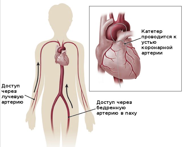 Коронарография сердца как делают
