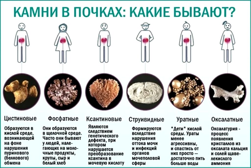 Кристаллы ураты в моче что это значит