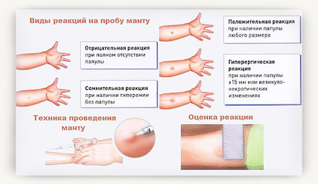 Манту у ребенка норма