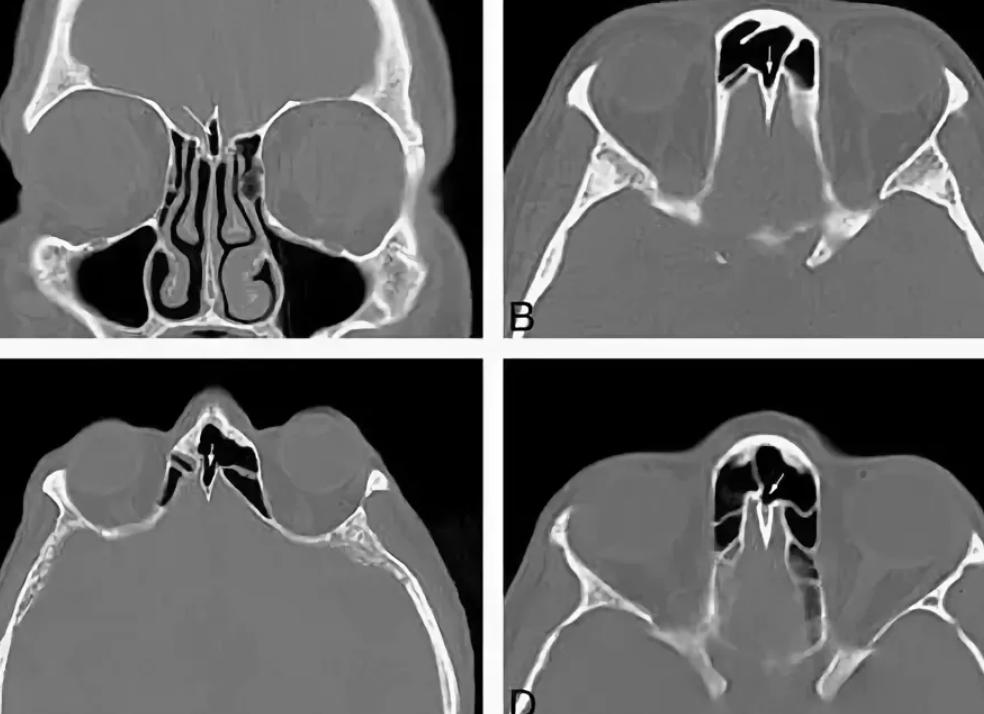 Мрт пазух носа что показывает