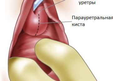 Мочевой канал у женщин