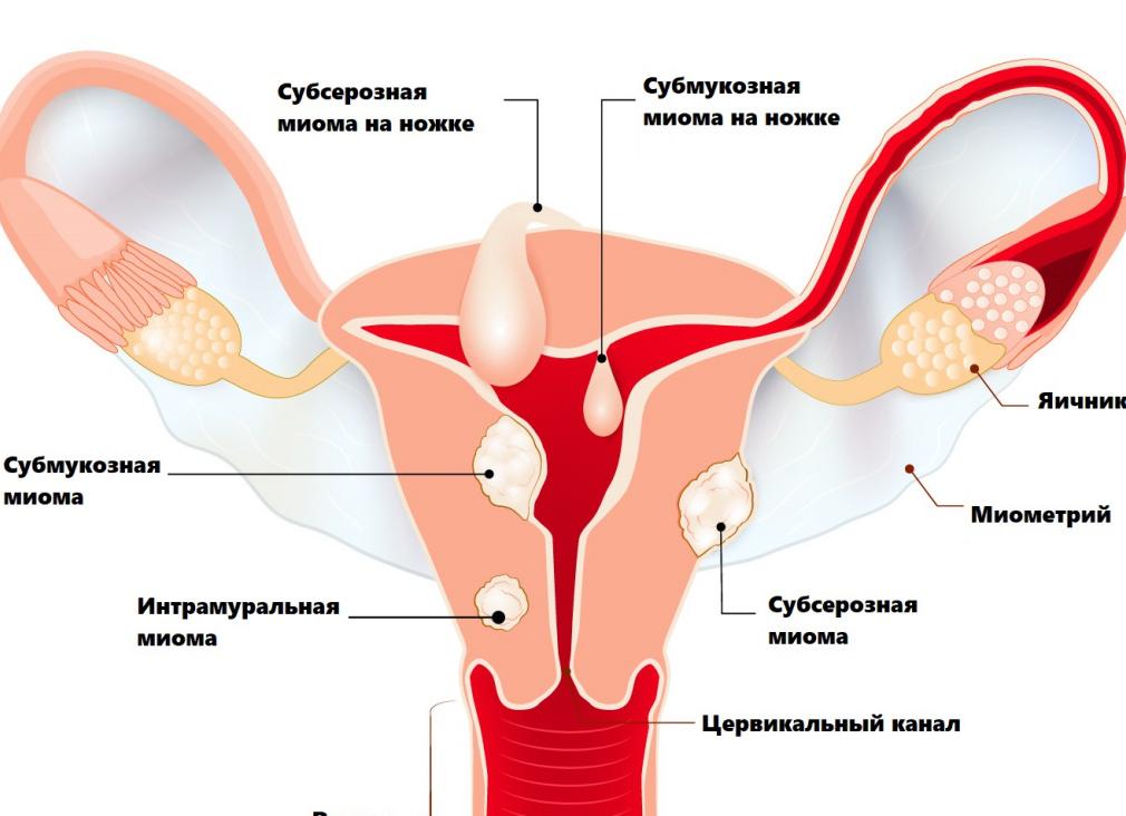 Миома матки что это такое фото