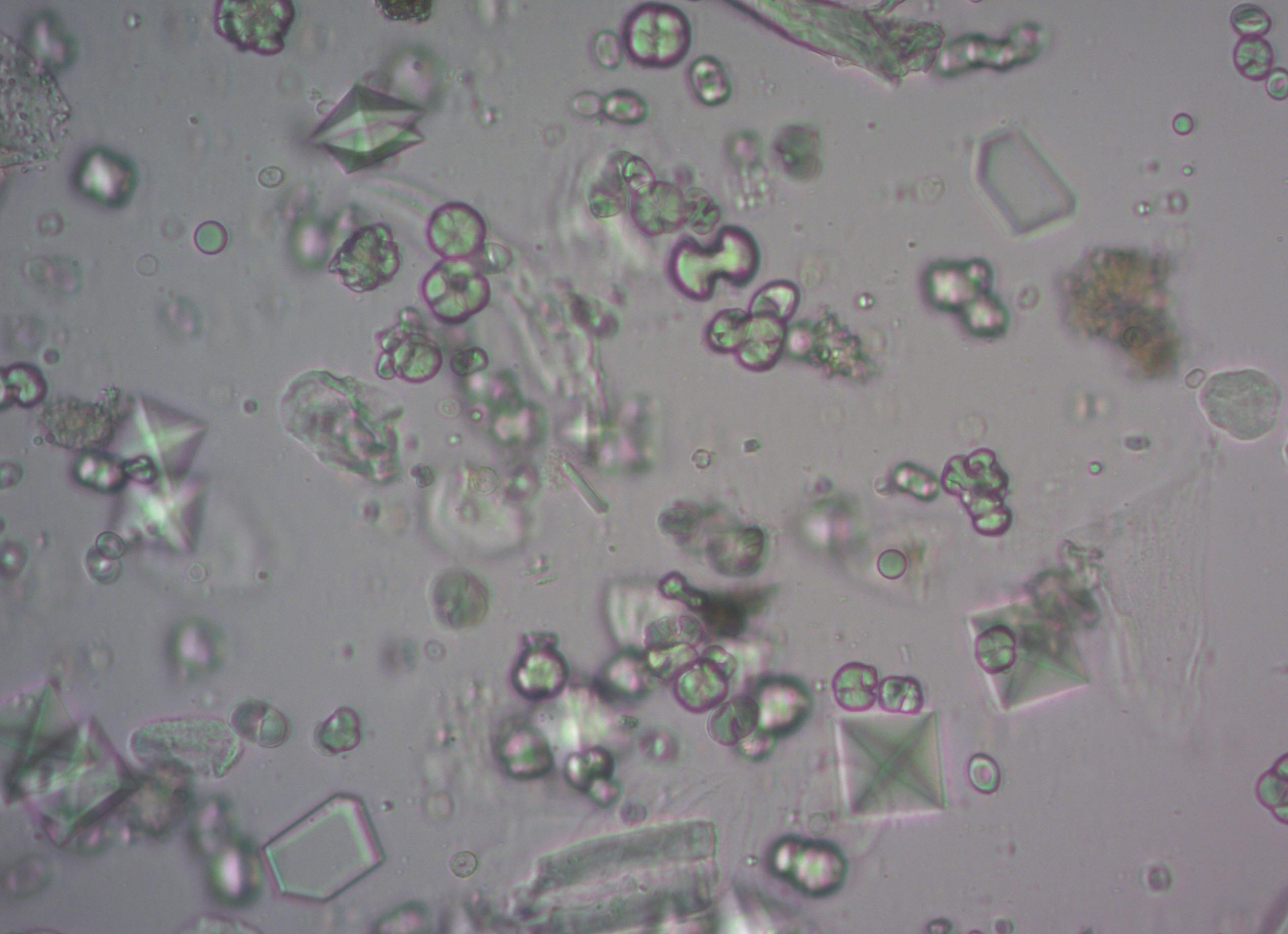 Кристаллы оксалата кальция в моче у ребенка Кристаллы оксалата кальция в моче у ребенка