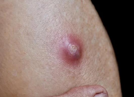 Кисты причины образования