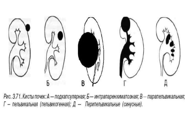 Киста интрапаренхиматозная почки