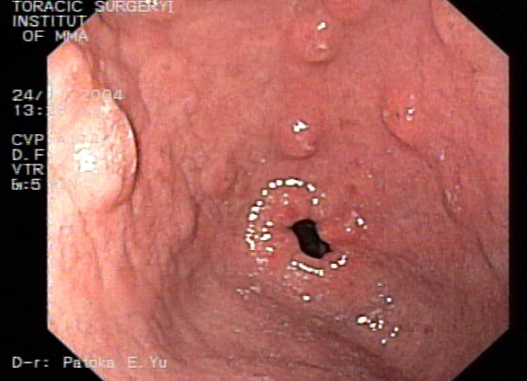 Как выглядит язва желудка