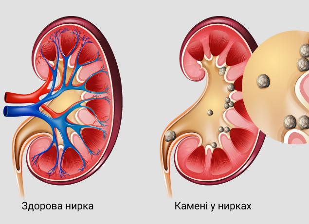 Как распознать болезнь почек