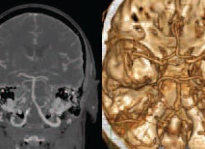 Интракраниальные сосуды головного мозга