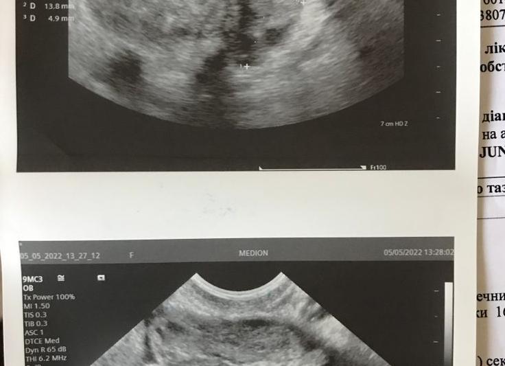 Гипоэхогенное образование в матке Гипоэхогенное образование в матке