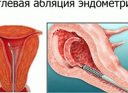 Гиперплазия эндометрия матки в менопаузе