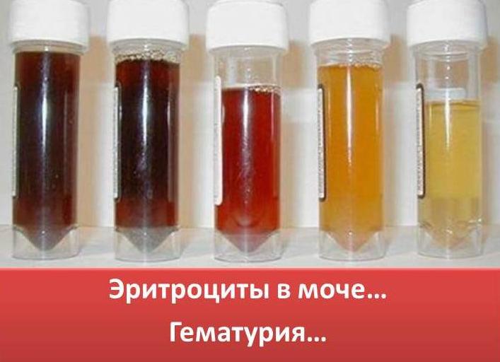 Гематурия у детей