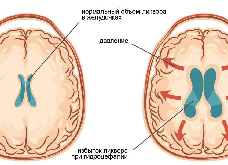 Фото гидроцефалия головного мозга