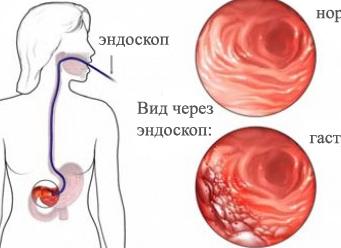 Если обострился гастрит что делать