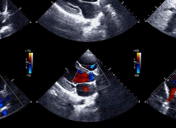 Эхокардиография с допплерографией сердца