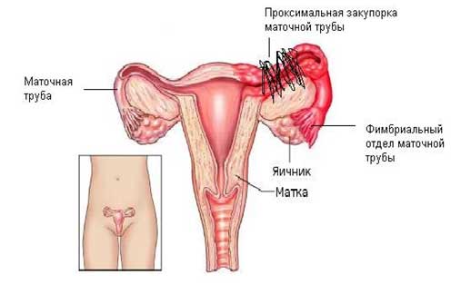 Как чистят трубы у женщин