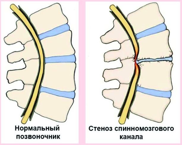 Как лечить стеноз позвоночного канала