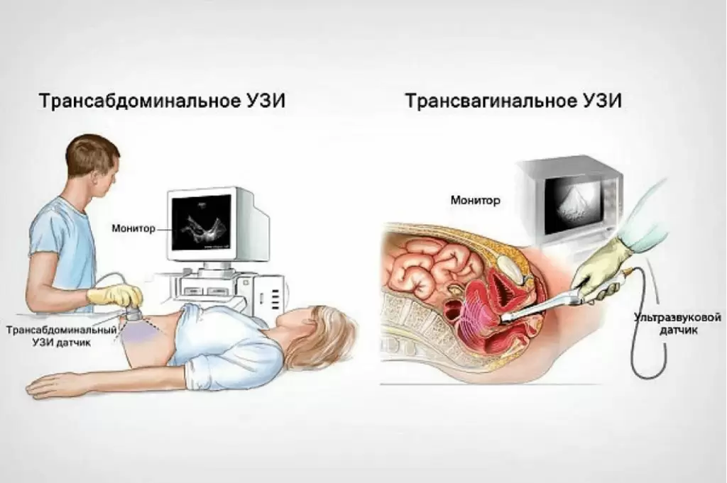 Как называется узи по гинекологии внутрь датчиком