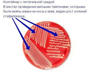 Мазок из зева на стафилококк