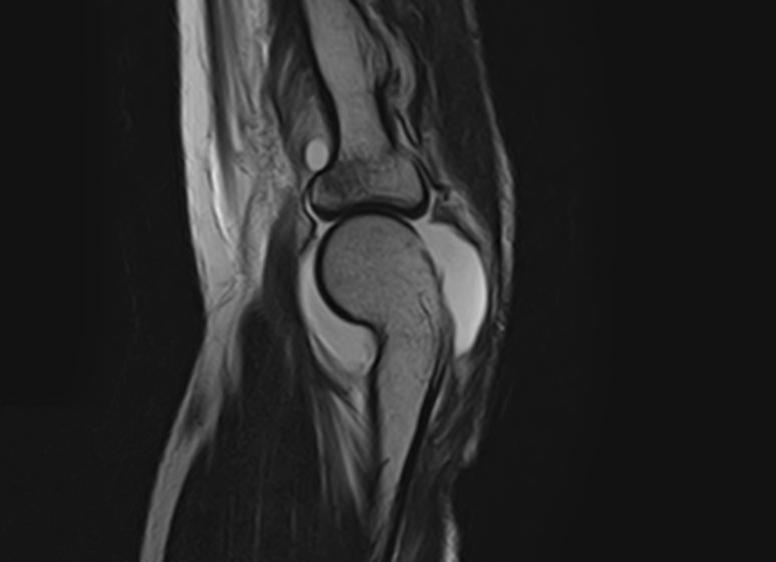 Мрт локтевого сустава